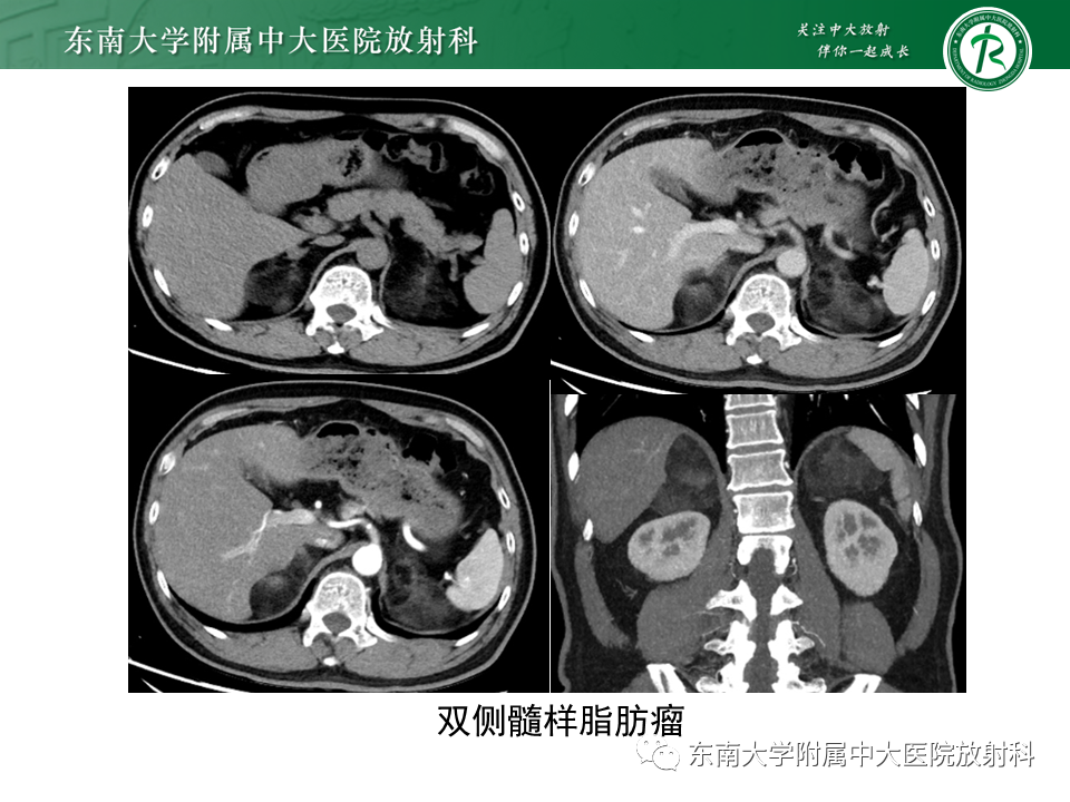 影像PPT - 【PPT】肾上腺嗜铬细胞瘤的影像诊断-29 影像PPT - 【PPT】肾上腺嗜铬细胞瘤的影像诊断-29