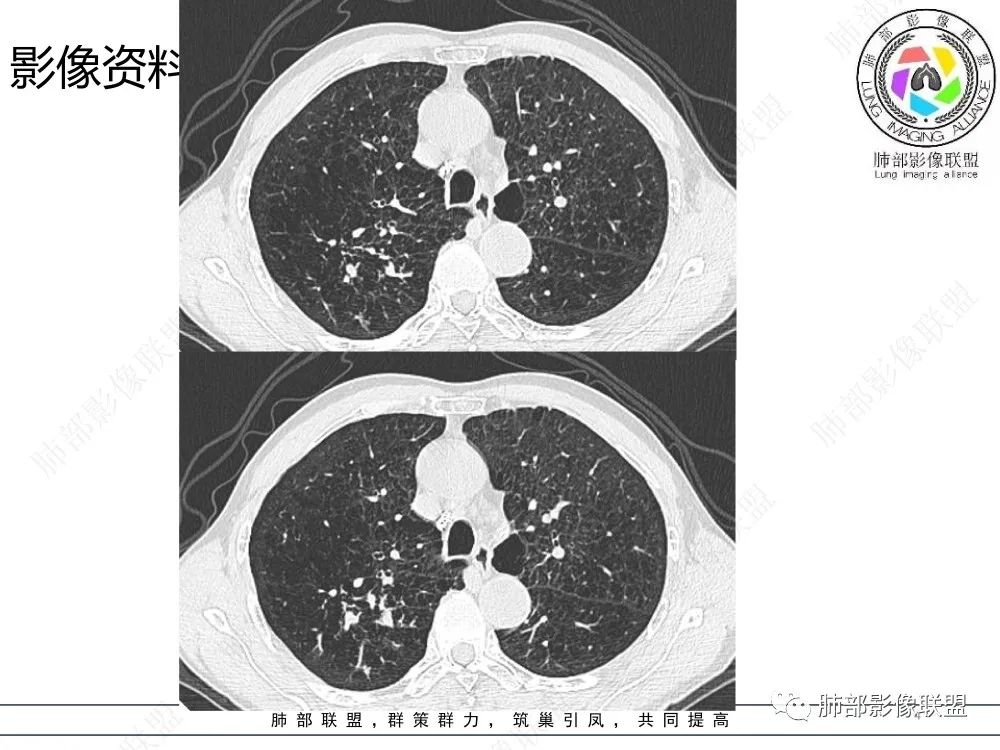 影像PPT - 【病例】指套征疾病谱及鉴别诊断-4 影像PPT - 【病例】指套征疾病谱及鉴别诊断-4