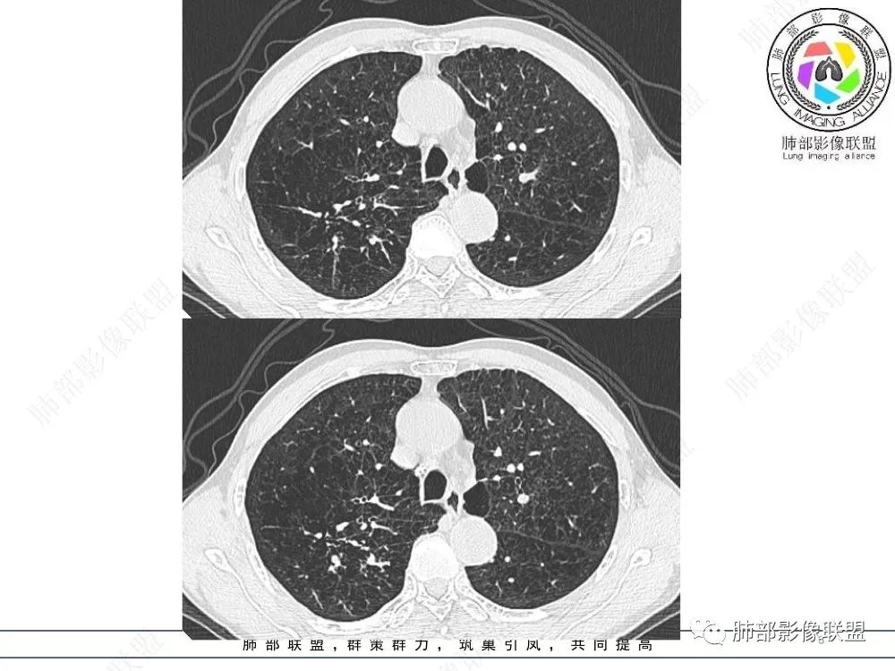 影像PPT - 【病例】指套征疾病谱及鉴别诊断-3 影像PPT - 【病例】指套征疾病谱及鉴别诊断-3