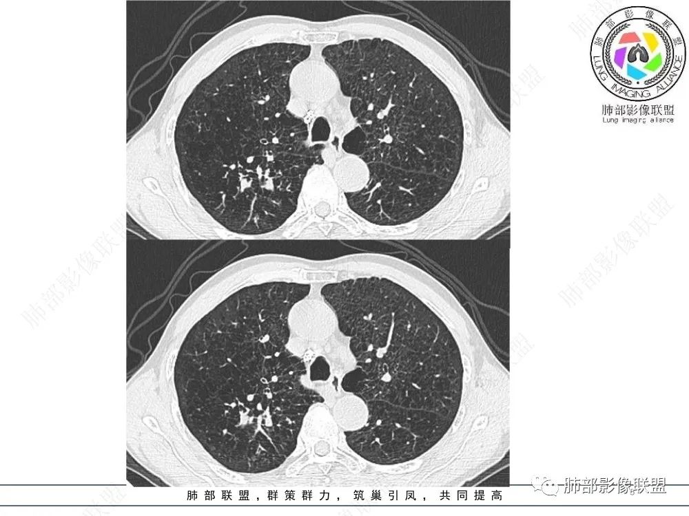 影像PPT - 【病例】指套征疾病谱及鉴别诊断-5 影像PPT - 【病例】指套征疾病谱及鉴别诊断-5
