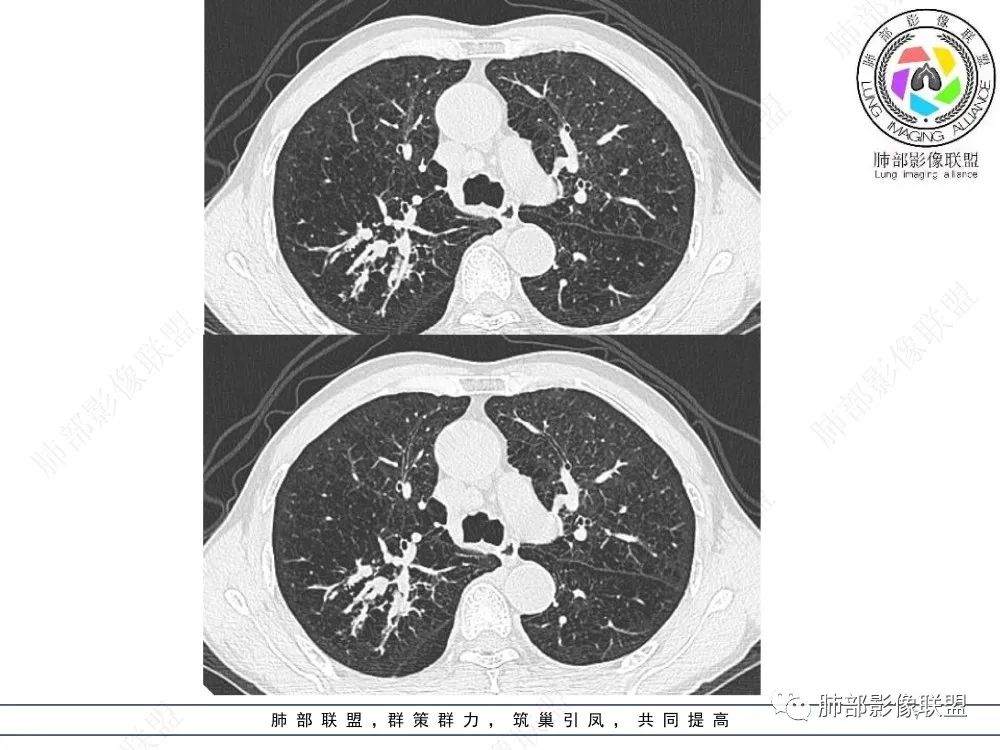 影像PPT - 【病例】指套征疾病谱及鉴别诊断-7 影像PPT - 【病例】指套征疾病谱及鉴别诊断-7