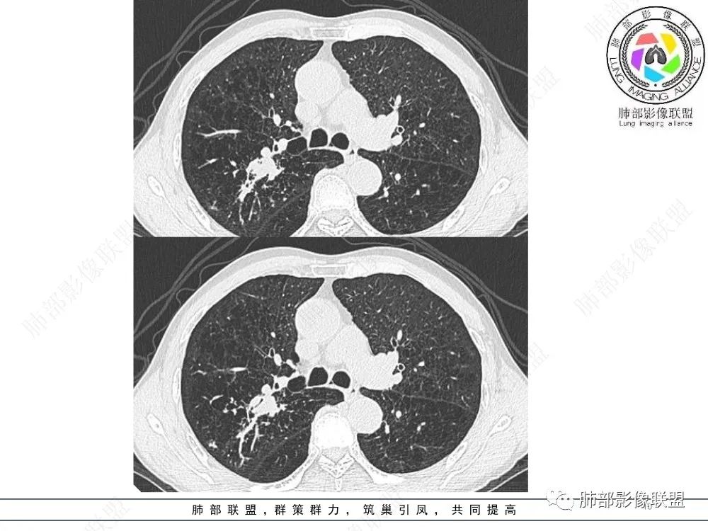 影像PPT - 【病例】指套征疾病谱及鉴别诊断-10 影像PPT - 【病例】指套征疾病谱及鉴别诊断-10