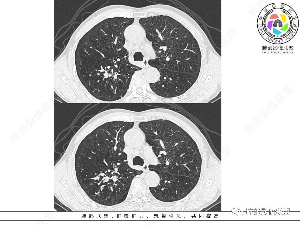 影像PPT - 【病例】指套征疾病谱及鉴别诊断-6 影像PPT - 【病例】指套征疾病谱及鉴别诊断-6