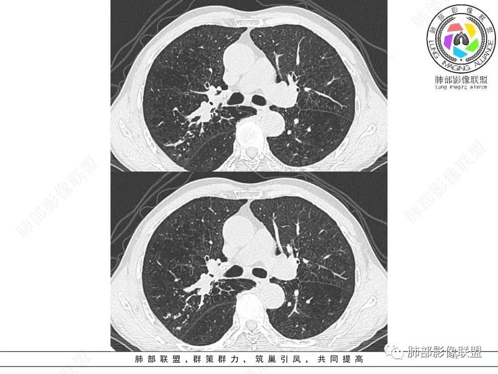 影像PPT - 【病例】指套征疾病谱及鉴别诊断-12 影像PPT - 【病例】指套征疾病谱及鉴别诊断-12
