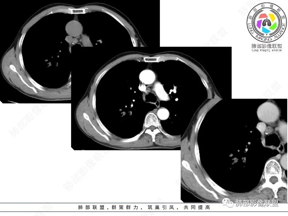 影像PPT - 【病例】指套征疾病谱及鉴别诊断-16 影像PPT - 【病例】指套征疾病谱及鉴别诊断-16