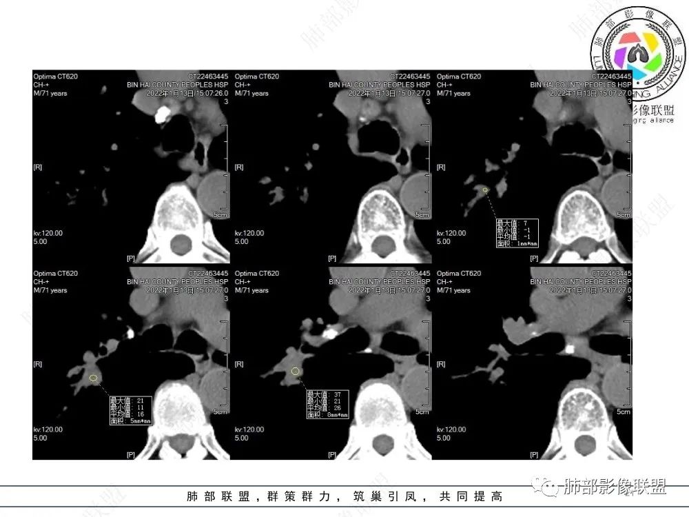 影像PPT - 【病例】指套征疾病谱及鉴别诊断-21 影像PPT - 【病例】指套征疾病谱及鉴别诊断-21