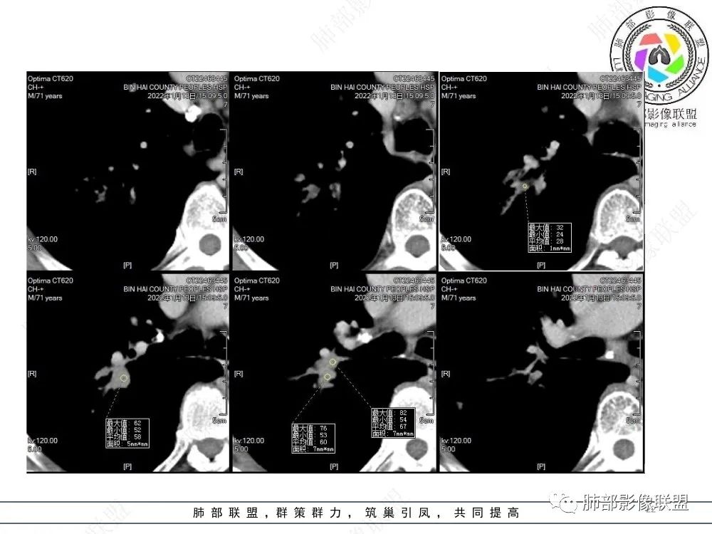 影像PPT - 【病例】指套征疾病谱及鉴别诊断-22 影像PPT - 【病例】指套征疾病谱及鉴别诊断-22