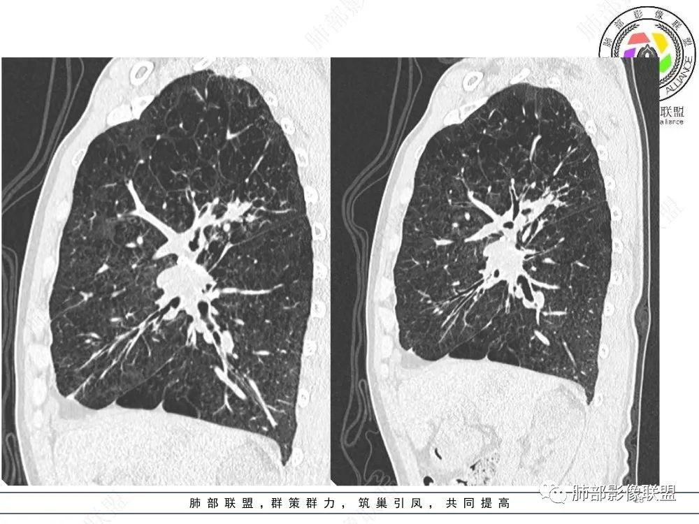 影像PPT - 【病例】指套征疾病谱及鉴别诊断-23 影像PPT - 【病例】指套征疾病谱及鉴别诊断-23
