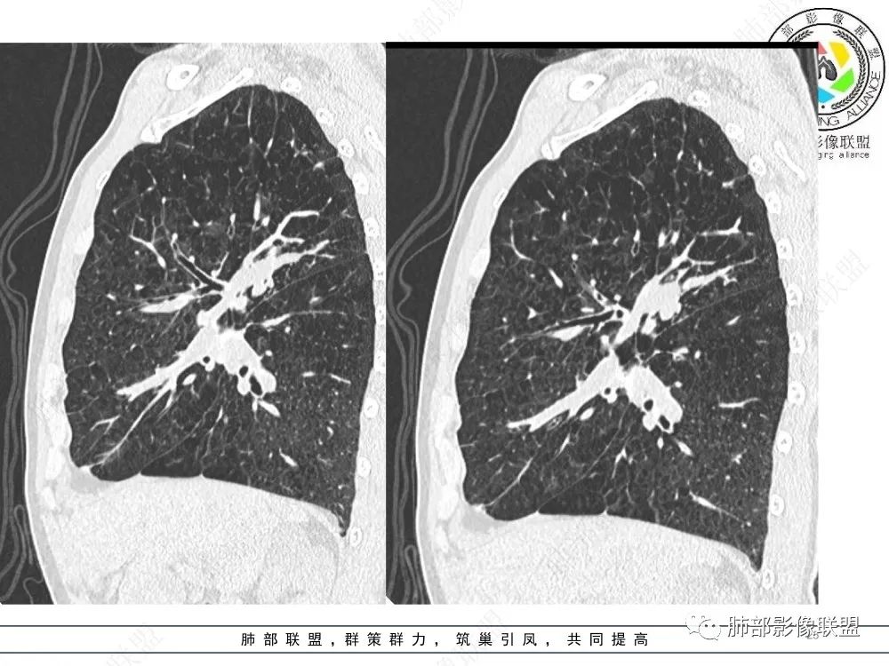 影像PPT - 【病例】指套征疾病谱及鉴别诊断-25 影像PPT - 【病例】指套征疾病谱及鉴别诊断-25