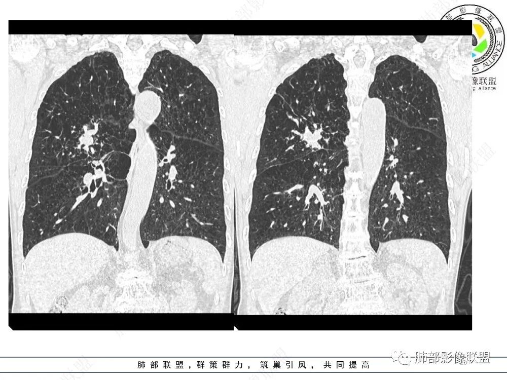影像PPT - 【病例】指套征疾病谱及鉴别诊断-26 影像PPT - 【病例】指套征疾病谱及鉴别诊断-26