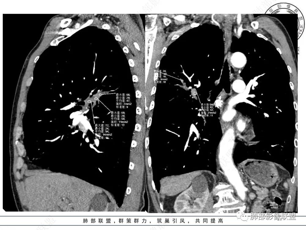 影像PPT - 【病例】指套征疾病谱及鉴别诊断-29 影像PPT - 【病例】指套征疾病谱及鉴别诊断-29