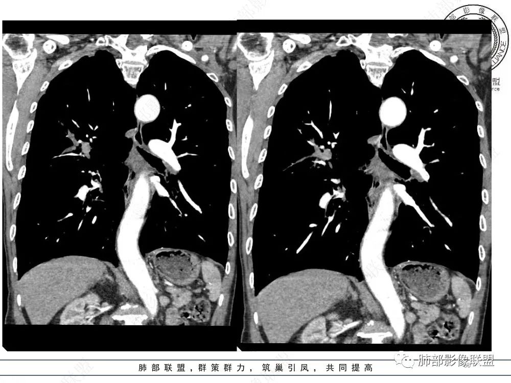 影像PPT - 【病例】指套征疾病谱及鉴别诊断-30 影像PPT - 【病例】指套征疾病谱及鉴别诊断-30
