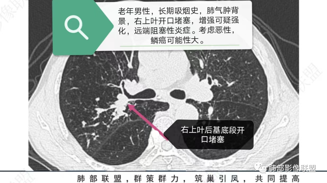 影像PPT - 【病例】指套征疾病谱及鉴别诊断-32 影像PPT - 【病例】指套征疾病谱及鉴别诊断-32