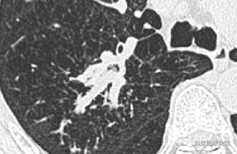 影像PPT - 【病例】指套征疾病谱及鉴别诊断-36 影像PPT - 【病例】指套征疾病谱及鉴别诊断-36
