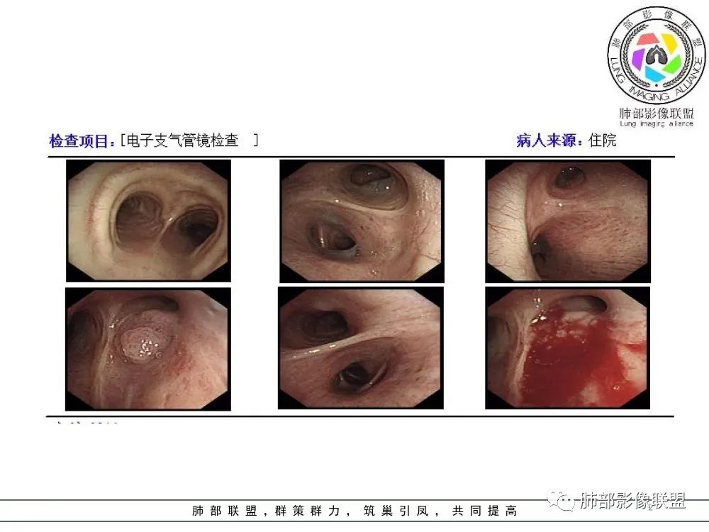 影像PPT - 【病例】指套征疾病谱及鉴别诊断-40 影像PPT - 【病例】指套征疾病谱及鉴别诊断-40