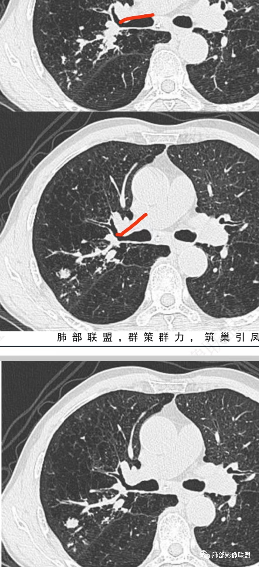 影像PPT - 【病例】指套征疾病谱及鉴别诊断-41 影像PPT - 【病例】指套征疾病谱及鉴别诊断-41
