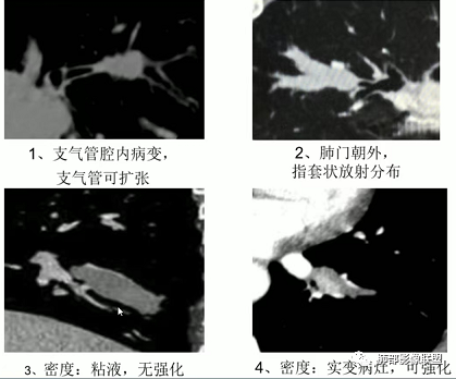 影像PPT - 【病例】指套征疾病谱及鉴别诊断-43 影像PPT - 【病例】指套征疾病谱及鉴别诊断-43