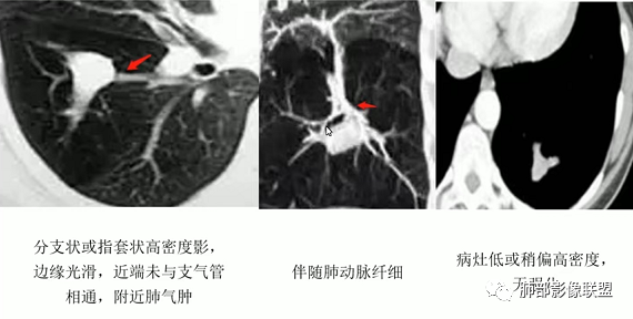 影像PPT - 【病例】指套征疾病谱及鉴别诊断-44 影像PPT - 【病例】指套征疾病谱及鉴别诊断-44