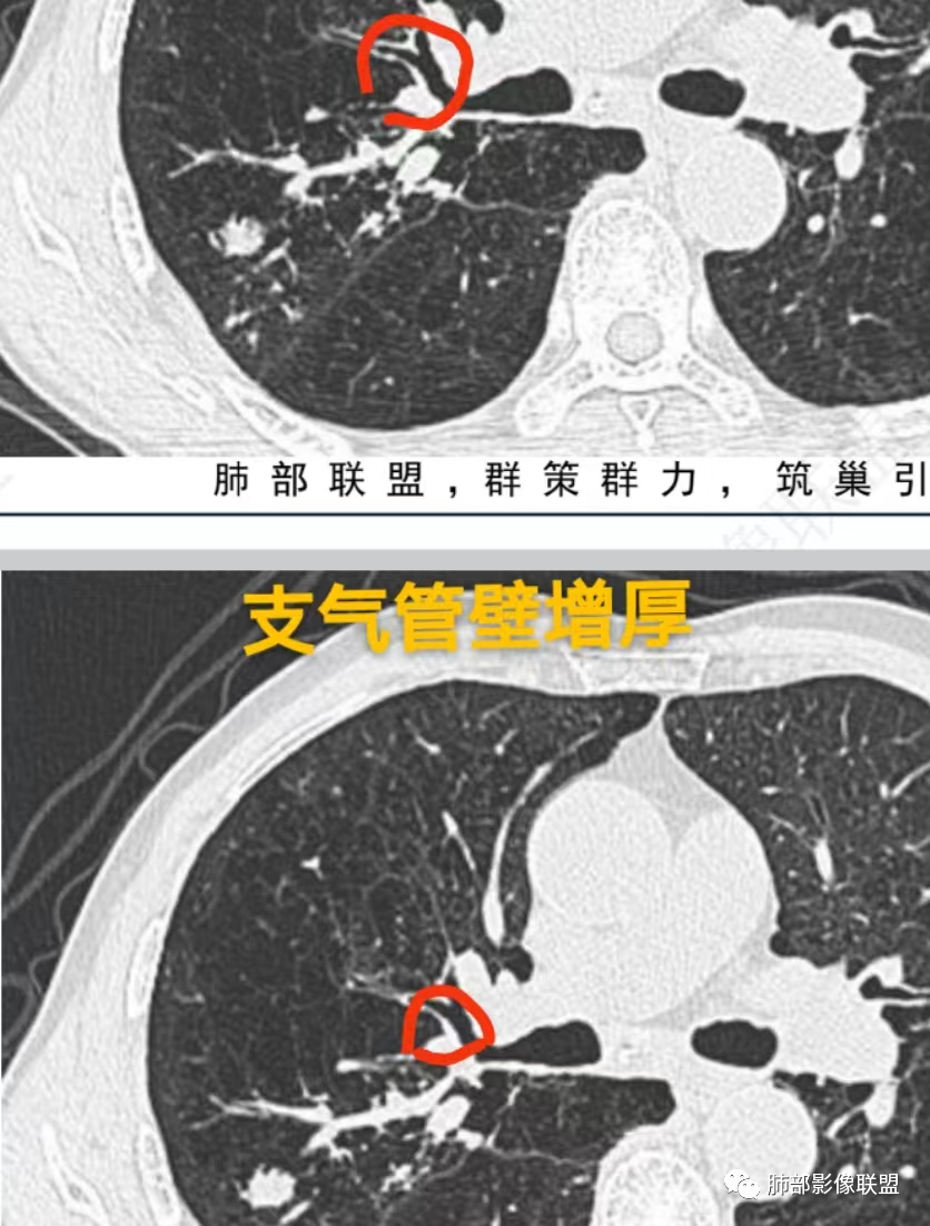影像PPT - 【病例】指套征疾病谱及鉴别诊断-42 影像PPT - 【病例】指套征疾病谱及鉴别诊断-42