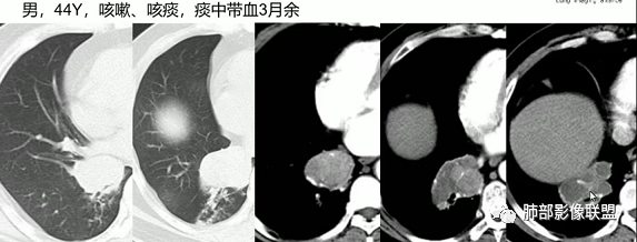 影像PPT - 【病例】指套征疾病谱及鉴别诊断-48 影像PPT - 【病例】指套征疾病谱及鉴别诊断-48