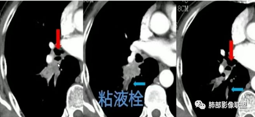 影像PPT - 【病例】指套征疾病谱及鉴别诊断-45 影像PPT - 【病例】指套征疾病谱及鉴别诊断-45