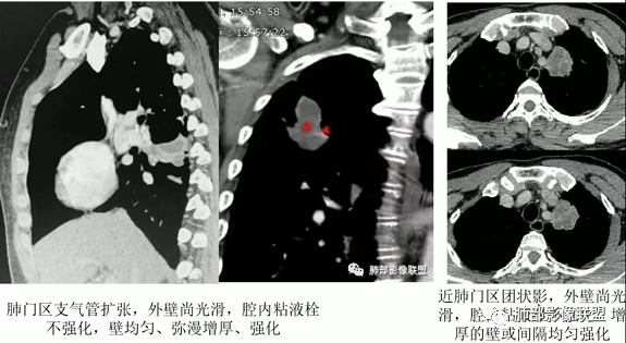 影像PPT - 【病例】指套征疾病谱及鉴别诊断-52 影像PPT - 【病例】指套征疾病谱及鉴别诊断-52