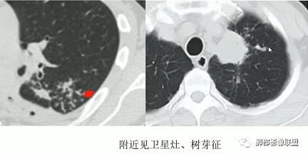 影像PPT - 【病例】指套征疾病谱及鉴别诊断-54 影像PPT - 【病例】指套征疾病谱及鉴别诊断-54
