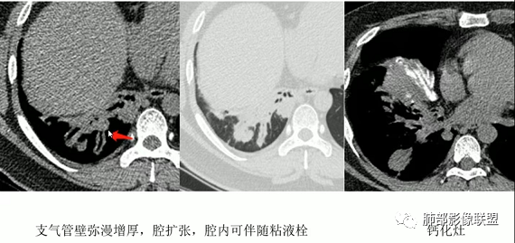 影像PPT - 【病例】指套征疾病谱及鉴别诊断-53 影像PPT - 【病例】指套征疾病谱及鉴别诊断-53
