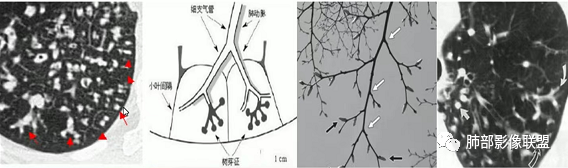 影像PPT - 【病例】指套征疾病谱及鉴别诊断-59 影像PPT - 【病例】指套征疾病谱及鉴别诊断-59