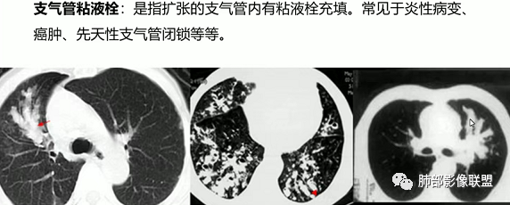 影像PPT - 【病例】指套征疾病谱及鉴别诊断-58 影像PPT - 【病例】指套征疾病谱及鉴别诊断-58