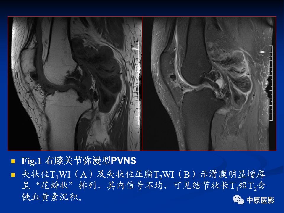 影像PPT - 【PPT】色素沉着绒毛结节性滑膜炎MRI诊断-16