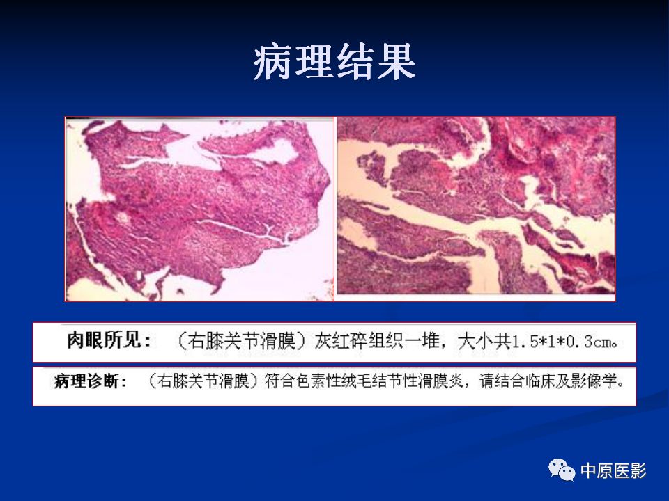 影像PPT - 【PPT】色素沉着绒毛结节性滑膜炎MRI诊断-18