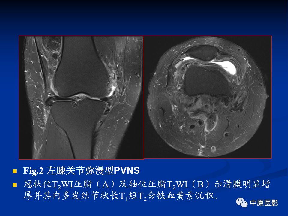 影像PPT - 【PPT】色素沉着绒毛结节性滑膜炎MRI诊断-22