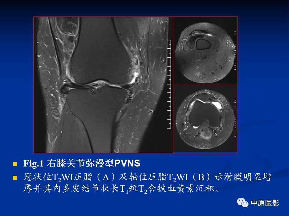 影像PPT - 【PPT】色素沉着绒毛结节性滑膜炎MRI诊断-17