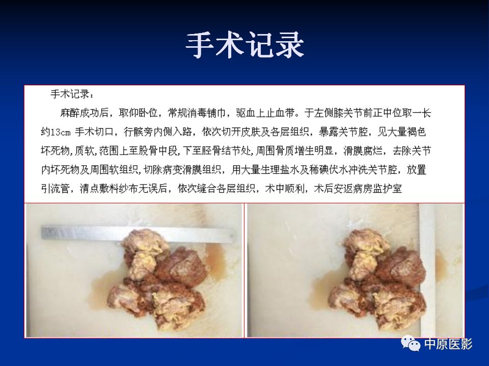 影像PPT - 【PPT】色素沉着绒毛结节性滑膜炎MRI诊断-23