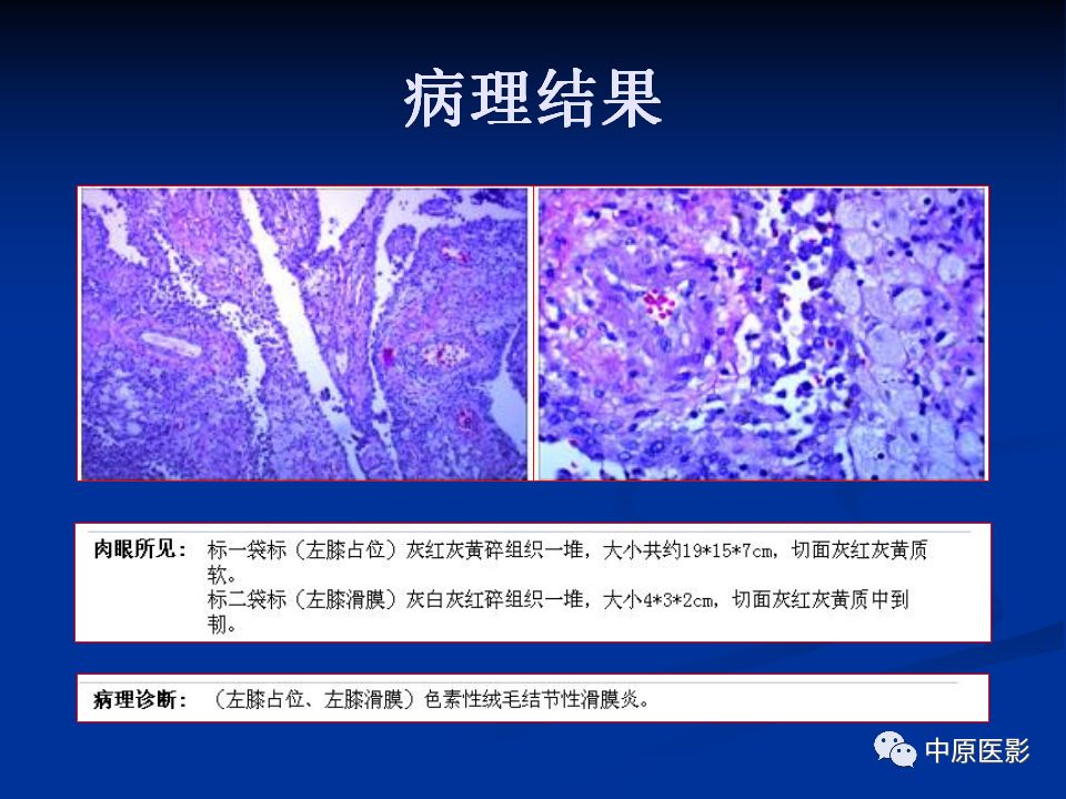 影像PPT - 【PPT】色素沉着绒毛结节性滑膜炎MRI诊断-24