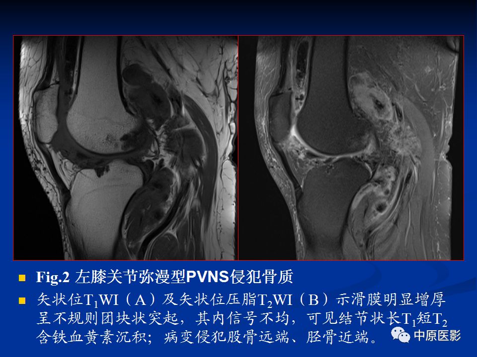 影像PPT - 【PPT】色素沉着绒毛结节性滑膜炎MRI诊断-21
