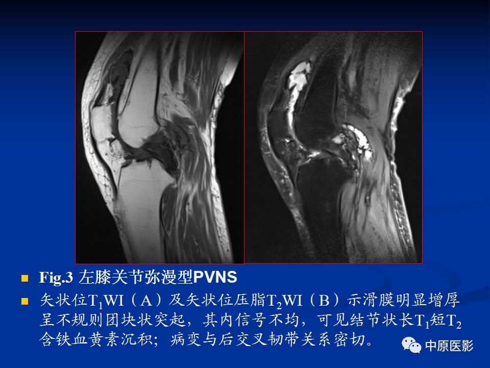 影像PPT - 【PPT】色素沉着绒毛结节性滑膜炎MRI诊断-27