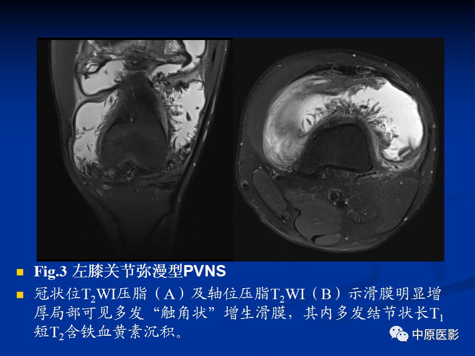 影像PPT - 【PPT】色素沉着绒毛结节性滑膜炎MRI诊断-28