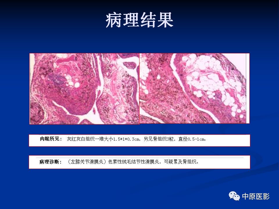 影像PPT - 【PPT】色素沉着绒毛结节性滑膜炎MRI诊断-30