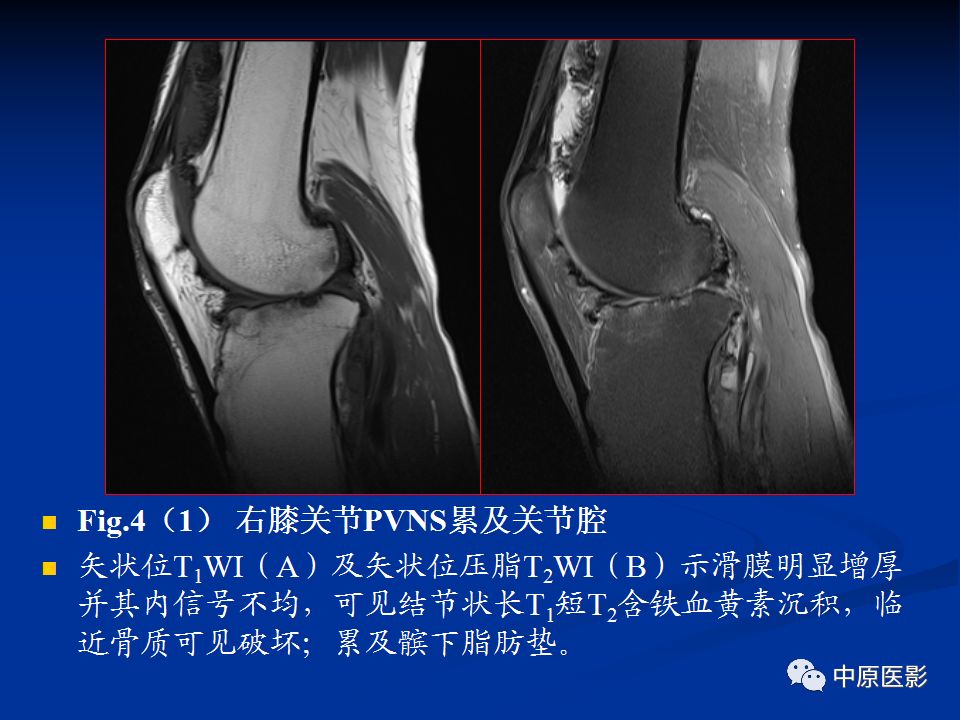影像PPT - 【PPT】色素沉着绒毛结节性滑膜炎MRI诊断-32