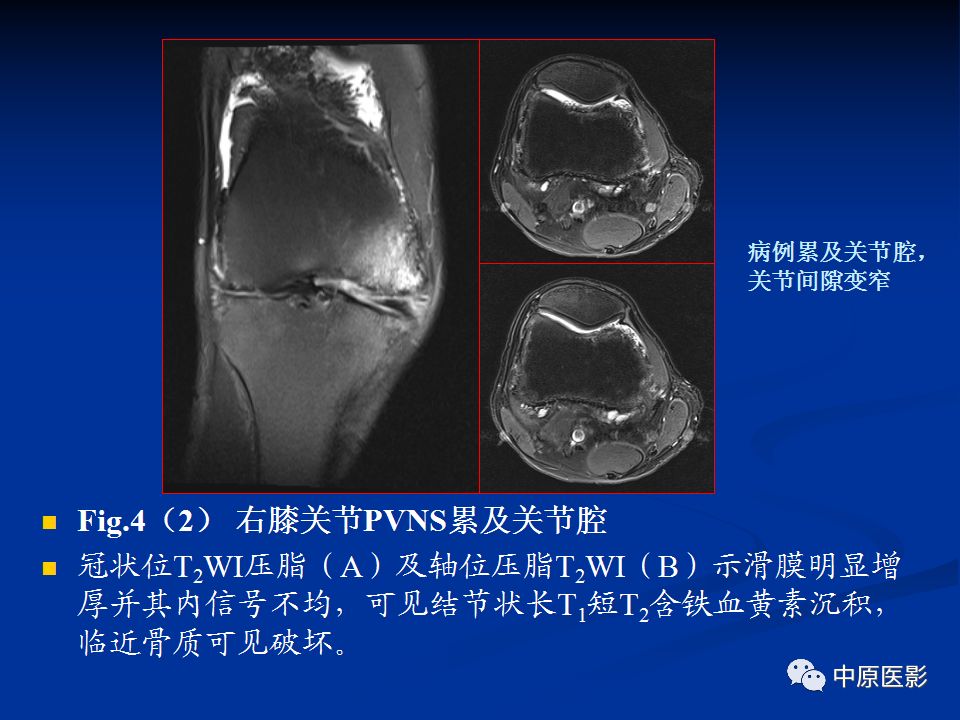 影像PPT - 【PPT】色素沉着绒毛结节性滑膜炎MRI诊断-33