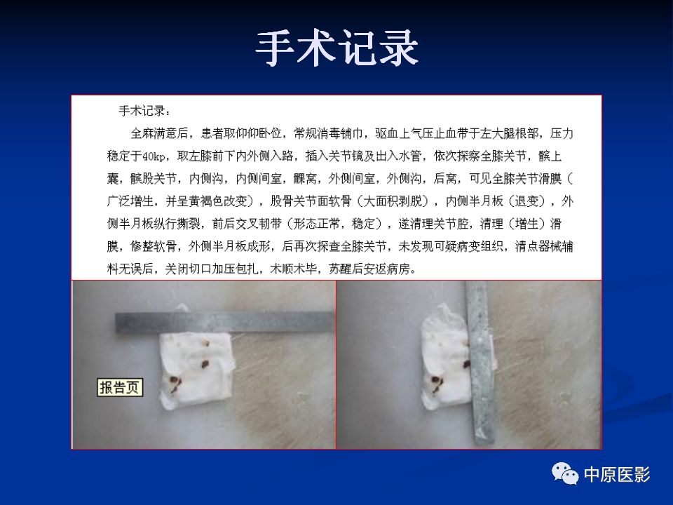影像PPT - 【PPT】色素沉着绒毛结节性滑膜炎MRI诊断-29
