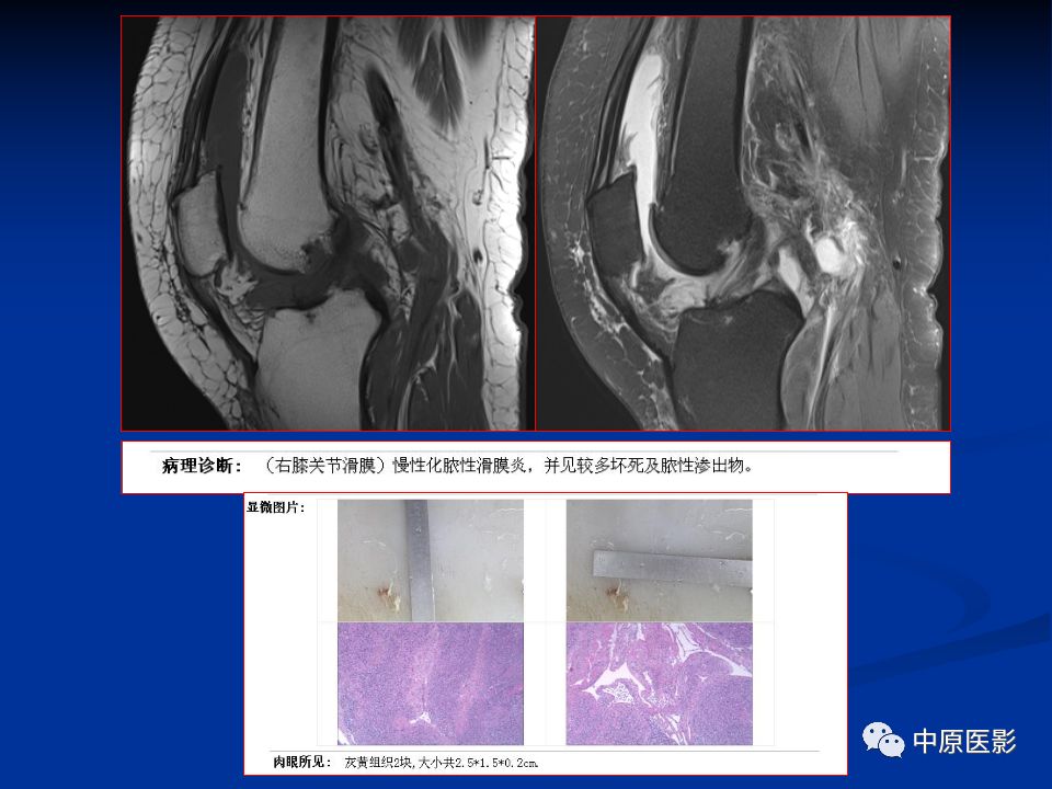 影像PPT - 【PPT】色素沉着绒毛结节性滑膜炎MRI诊断-36