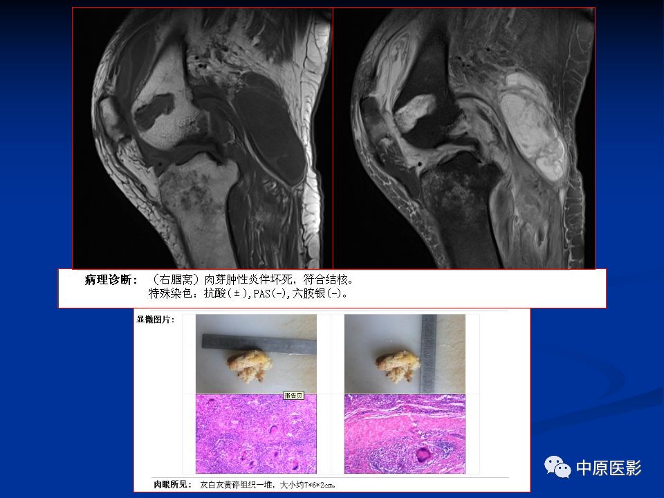 影像PPT - 【PPT】色素沉着绒毛结节性滑膜炎MRI诊断-38
