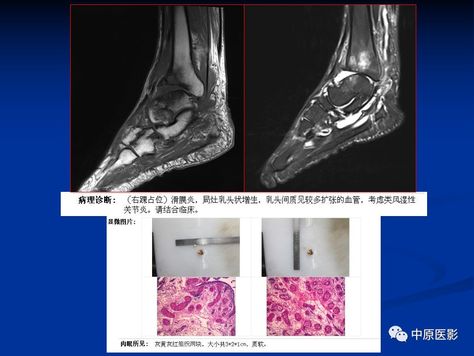 影像PPT - 【PPT】色素沉着绒毛结节性滑膜炎MRI诊断-40