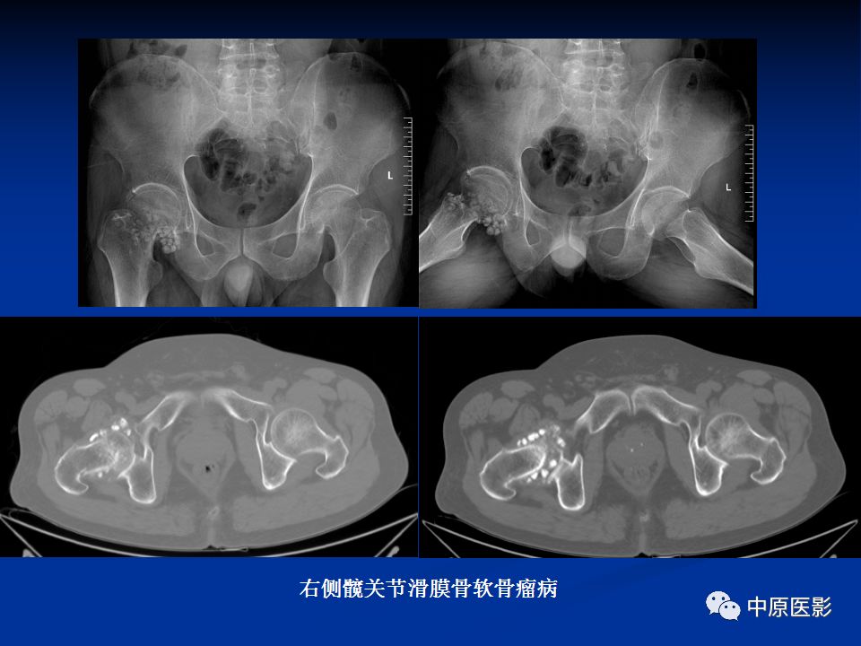 影像PPT - 【PPT】色素沉着绒毛结节性滑膜炎MRI诊断-42