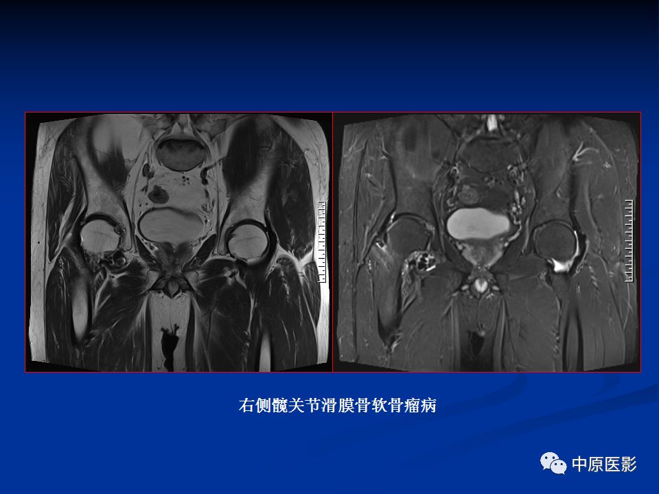 影像PPT - 【PPT】色素沉着绒毛结节性滑膜炎MRI诊断-43