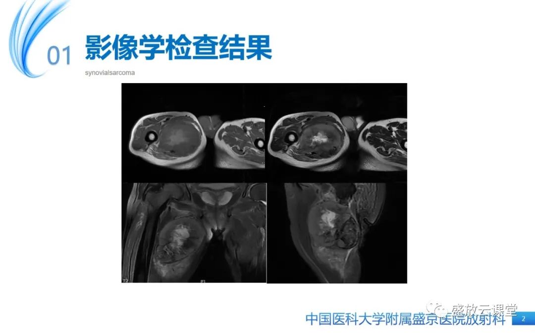 影像PPT - 【PPT】滑膜肉瘤-2