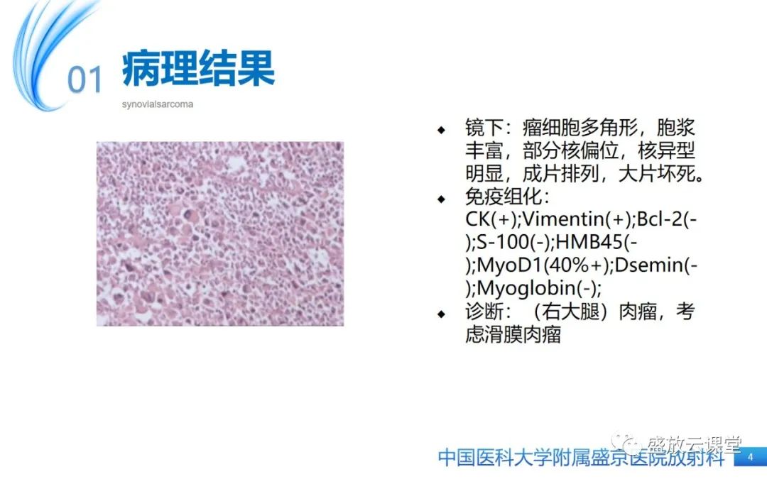 影像PPT - 【PPT】滑膜肉瘤-4